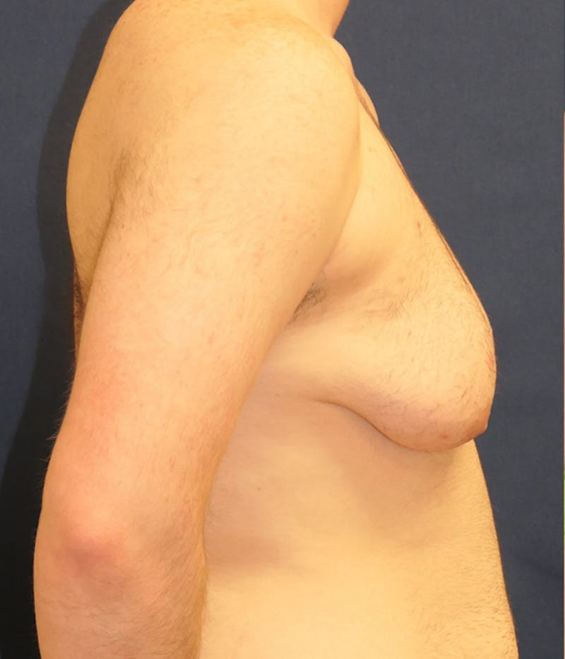 Masculinizing Surgery Before & After Gallery - Patient 174341 - Image 3