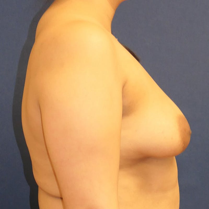 Breast Reconstruction with Implants Only Before & After Gallery - Patient 340658 - Image 5