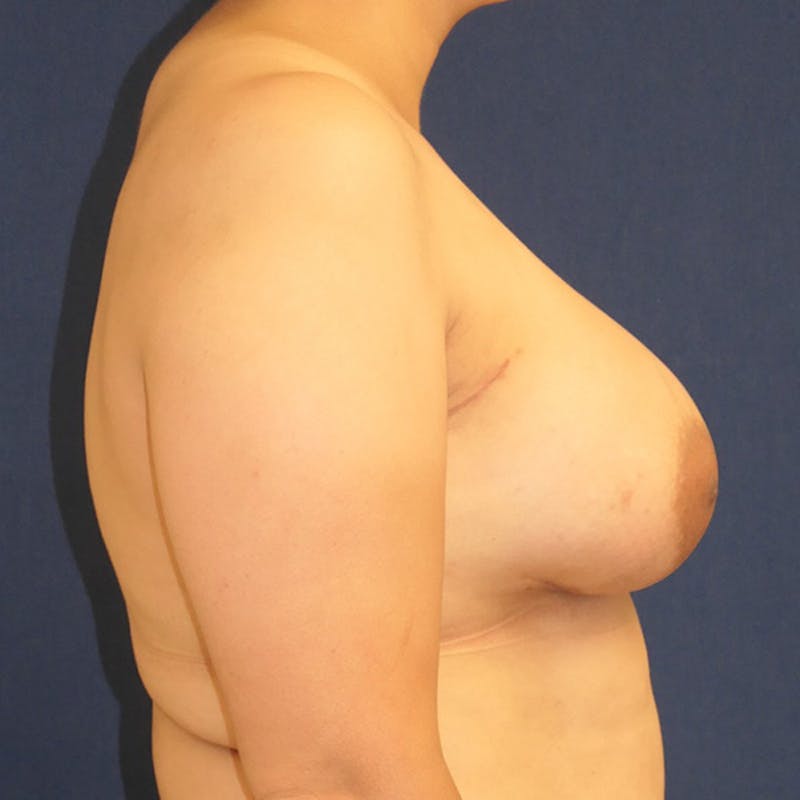 Breast Reconstruction with Implants Only Before & After Gallery - Patient 340658 - Image 6