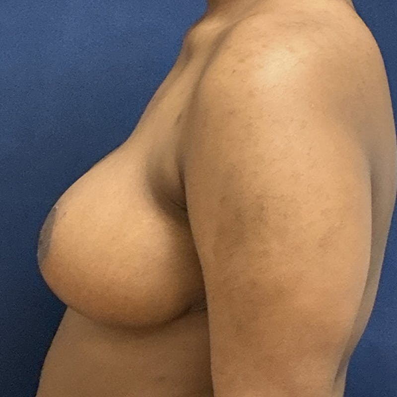 Breast Lift Before & After Gallery - Patient 148086 - Image 6