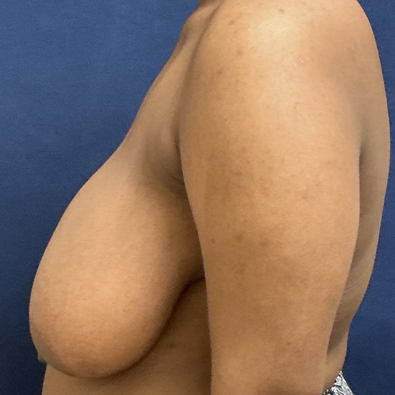 Breast Lift Before & After Gallery - Patient 148086 - Image 5