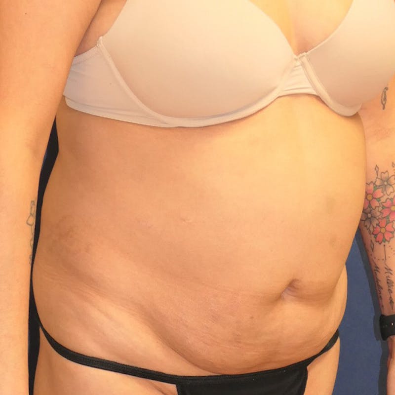 Tummy Tuck (Abdominoplasty) Before & After Gallery - Patient 349456 - Image 3