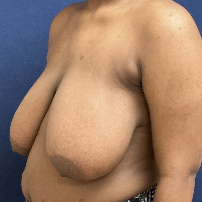 Breast Lift Before & After Gallery - Patient 148086 - Image 3