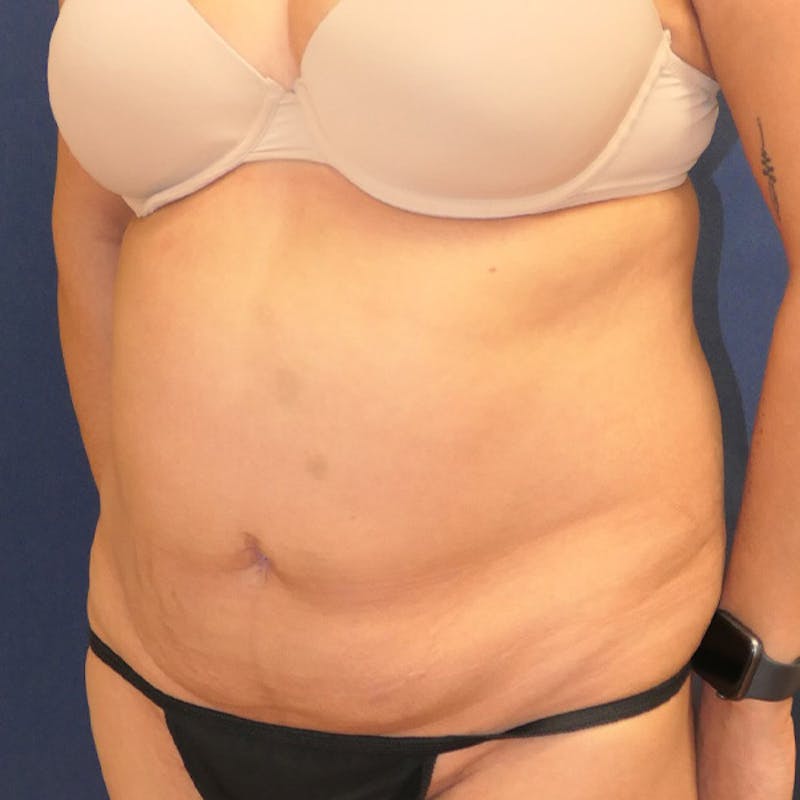 Tummy Tuck (Abdominoplasty) Before & After Gallery - Patient 349456 - Image 7