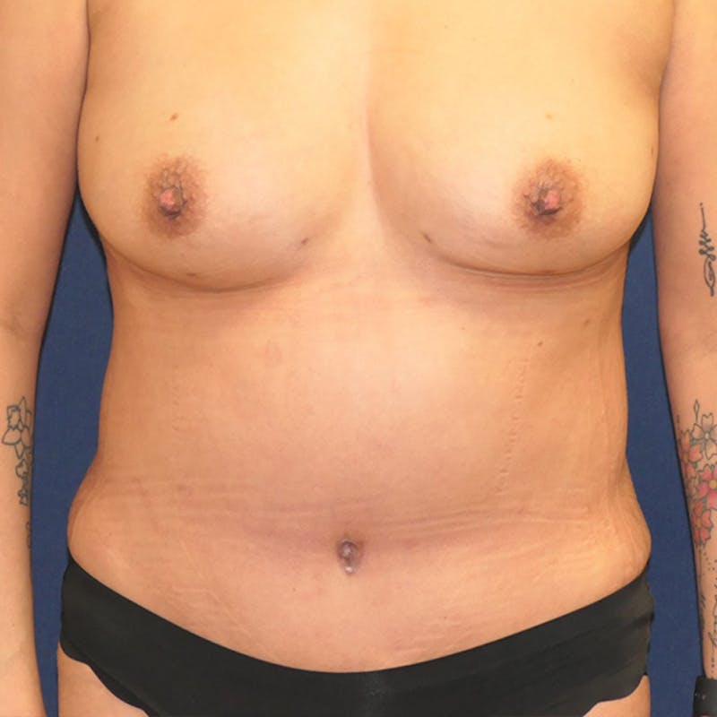 Tummy Tuck (Abdominoplasty) Before & After Gallery - Patient 349456 - Image 2