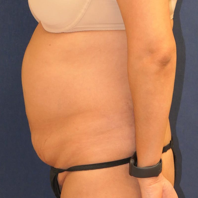 Tummy Tuck (Abdominoplasty) Before & After Gallery - Patient 349456 - Image 9