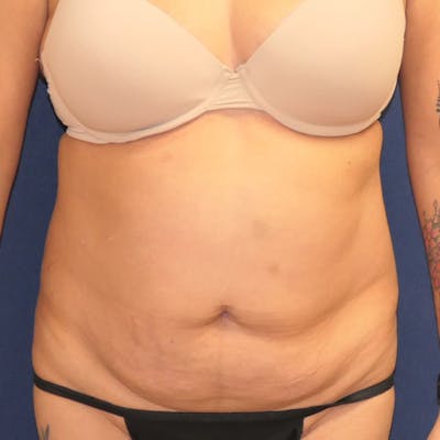 Tummy Tuck (Abdominoplasty) Before & After Gallery - Patient 349456 - Image 1