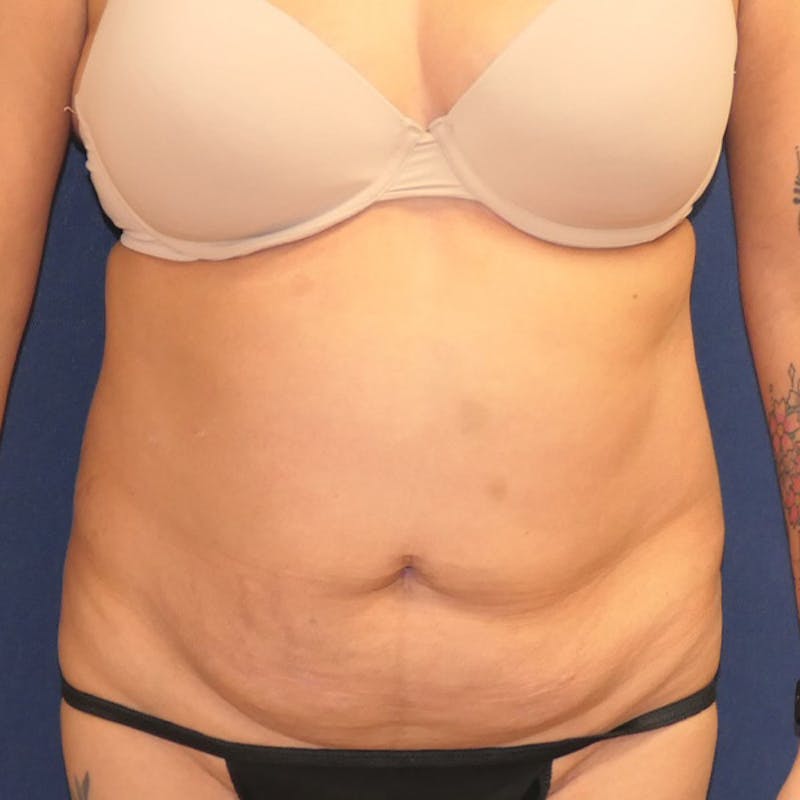 Tummy Tuck (Abdominoplasty) Before & After Gallery - Patient 349456 - Image 1