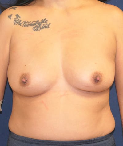 Breast Augmentation Before & After Gallery - Patient 239873 - Image 1