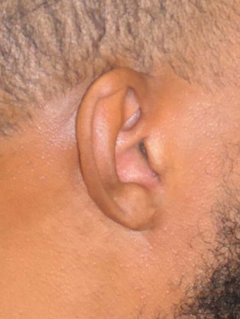 Scars/Malformations Before & After Gallery - Patient 814367 - Image 4