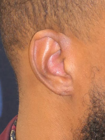 Scars/Malformations Before & After Gallery - Patient 814367 - Image 2