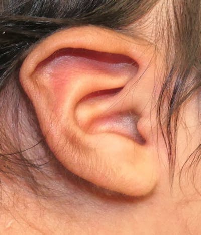 Ear Molding Before & After Gallery - Patient 274814 - Image 1