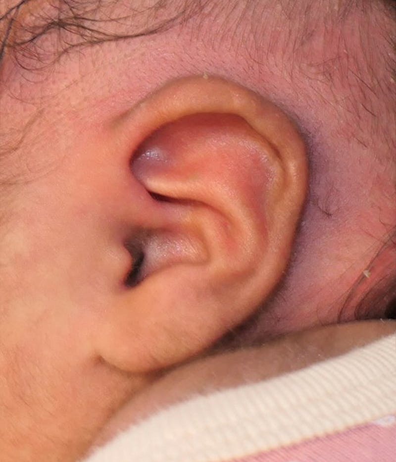 Ear Molding Before & After Gallery - Patient 274814 - Image 4