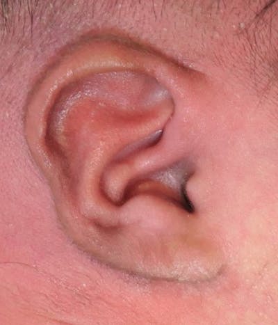 Ear Molding Before & After Gallery - Patient 274814 - Image 2