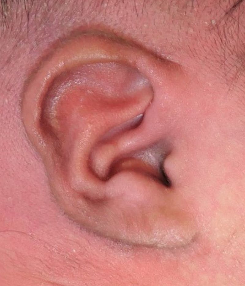 Ear Molding Before & After Gallery - Patient 274814 - Image 2