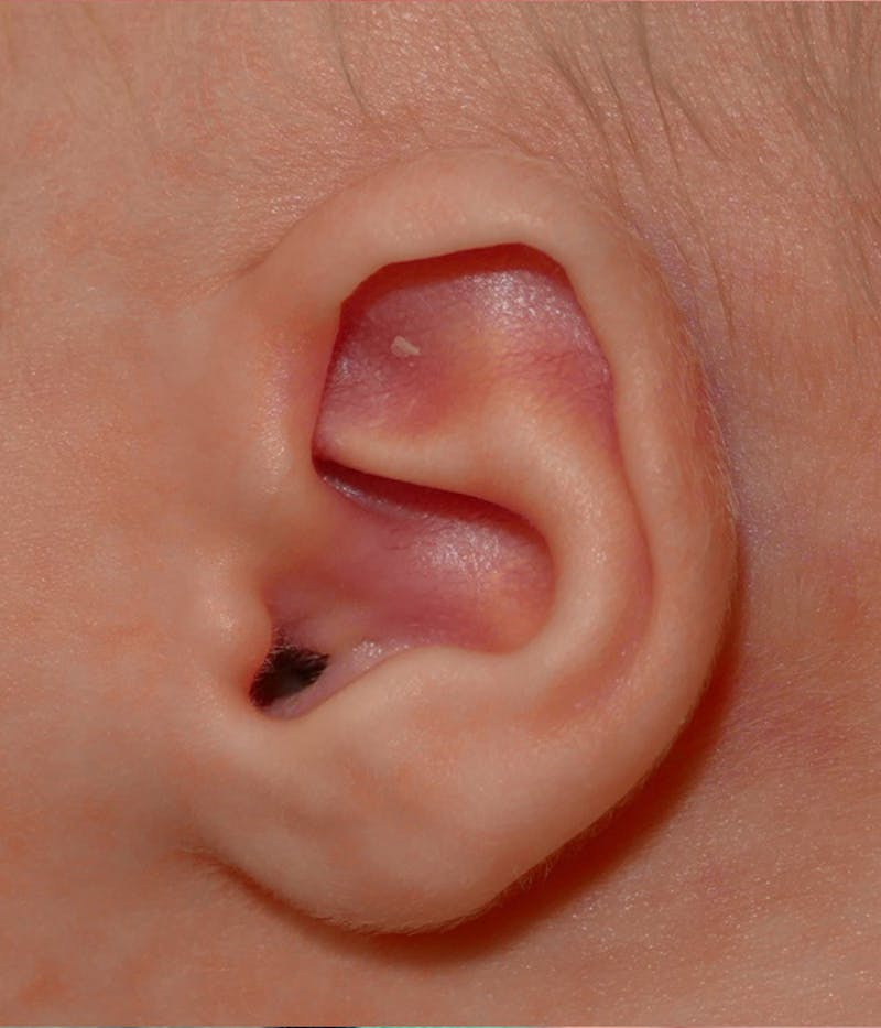 Ear Molding Before & After Gallery - Patient 197742 - Image 3