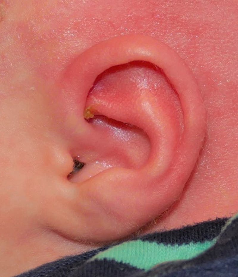 Ear Molding Before & After Gallery - Patient 197742 - Image 4