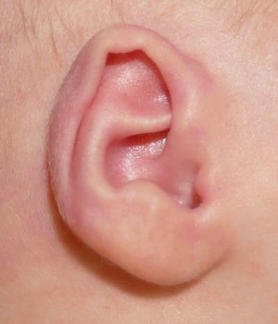Ear Molding Before & After Gallery - Patient 197742 - Image 1