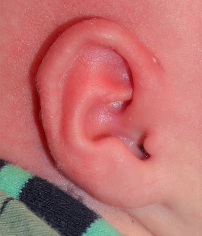 Ear Molding Before & After Gallery - Patient 197742 - Image 2