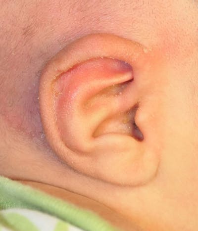 Ear Molding Before & After Gallery - Patient 174465 - Image 2