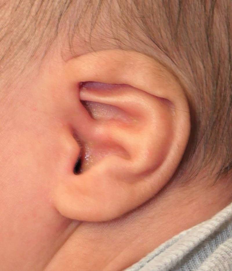 Ear Molding Before & After Gallery - Patient 174465 - Image 3