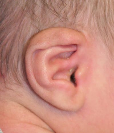 Ear Molding Before & After Gallery - Patient 174465 - Image 1