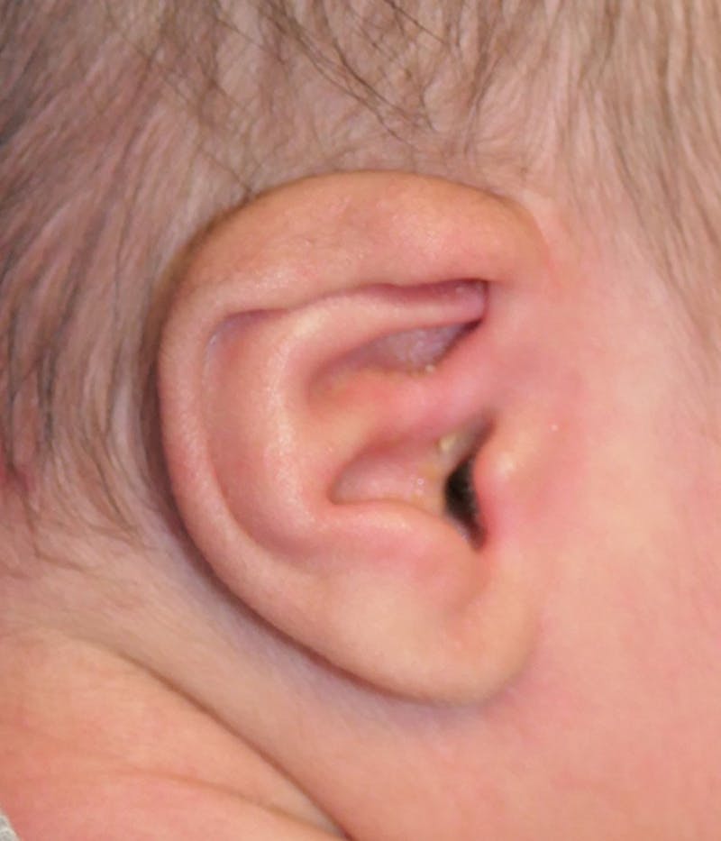 Ear Molding Before & After Gallery - Patient 174465 - Image 1