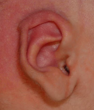 Ear Molding Before & After Gallery - Patient 214834 - Image 2