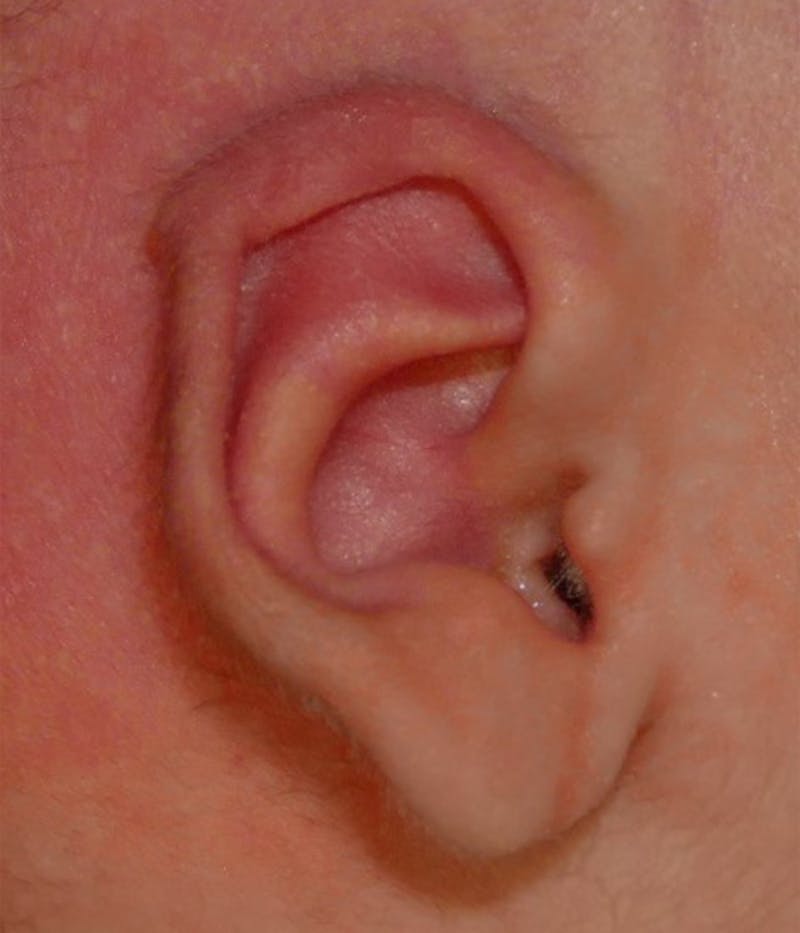 Pediatric Ear Molding Before & After Gallery - Patient 373944 - Image 2