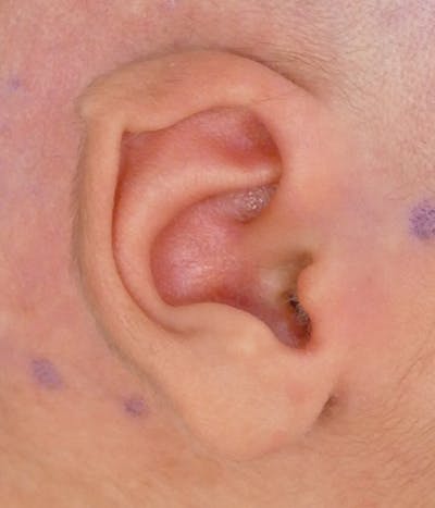 Ear Molding Before & After Gallery - Patient 214834 - Image 1