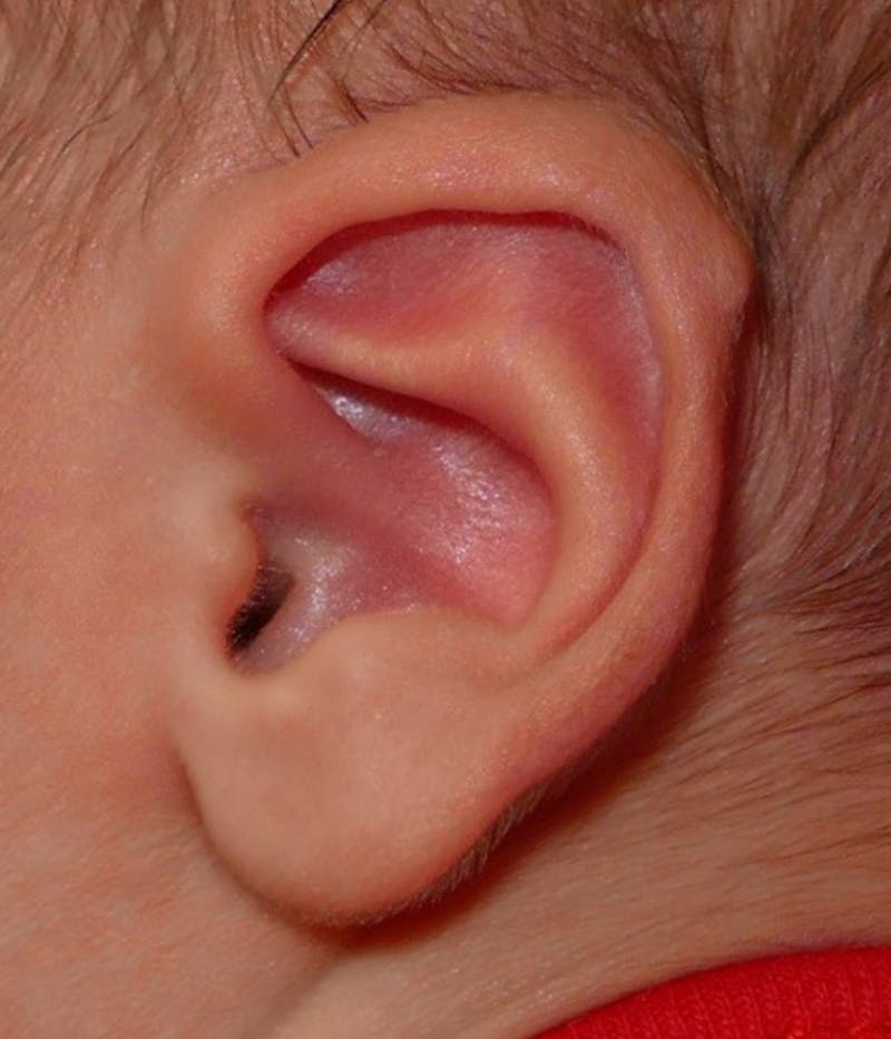 Pediatric Ear Molding Before & After Gallery - Patient 373944 - Image 3