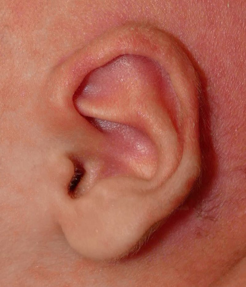 Pediatric Ear Molding Before & After Gallery - Patient 373944 - Image 4