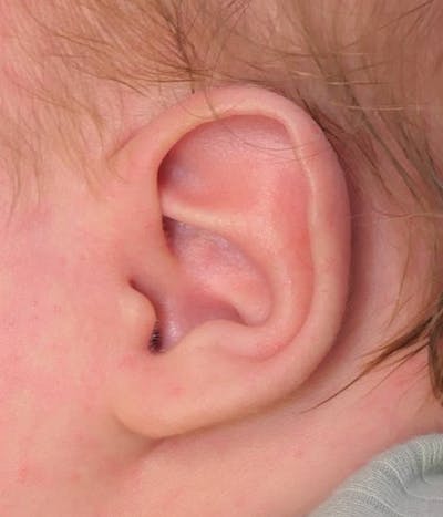 Ear Molding Before & After Gallery - Patient 267091 - Image 1