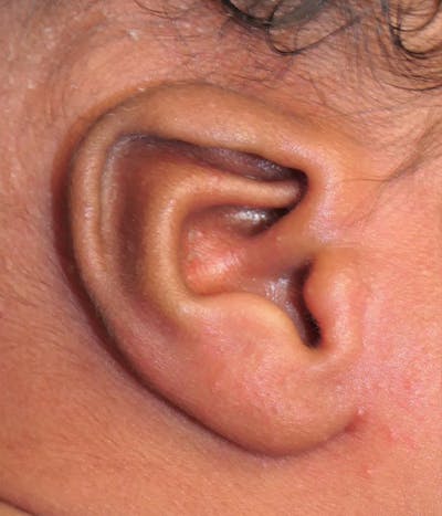 Ear Molding Before & After Gallery - Patient 220916 - Image 1