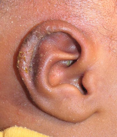 Ear Molding Before & After Gallery - Patient 220916 - Image 2