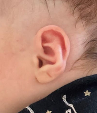 Ear Molding Before & After Gallery - Patient 263076 - Image 2