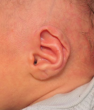 Ear Molding Before & After Gallery - Patient 263076 - Image 1