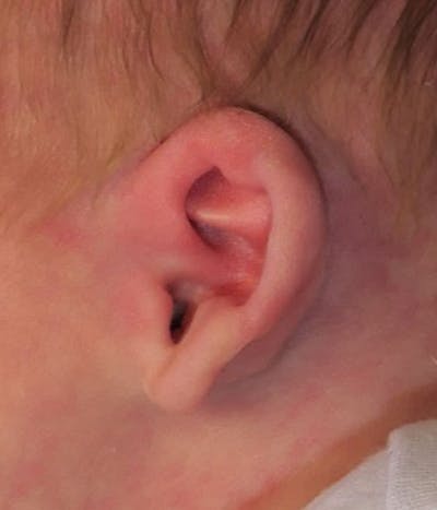Ear Molding Before & After Gallery - Patient 768207 - Image 1