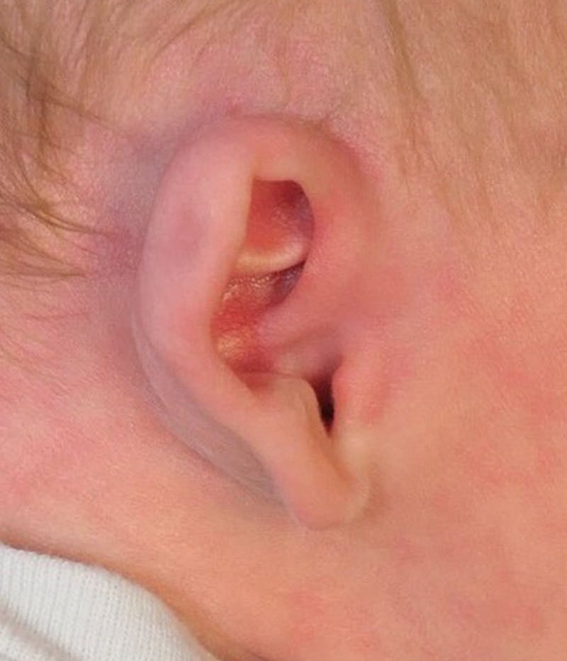 Ear Molding Before & After Gallery - Patient 768207 - Image 3
