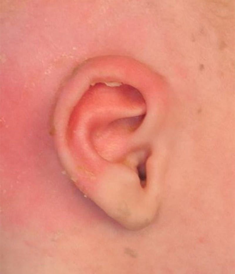 Ear Molding Before & After Gallery - Patient 768207 - Image 4