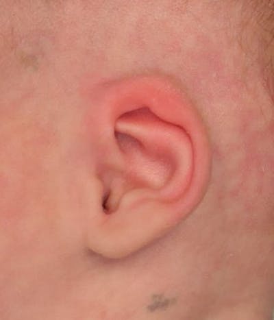 Ear Molding Before & After Gallery - Patient 768207 - Image 2