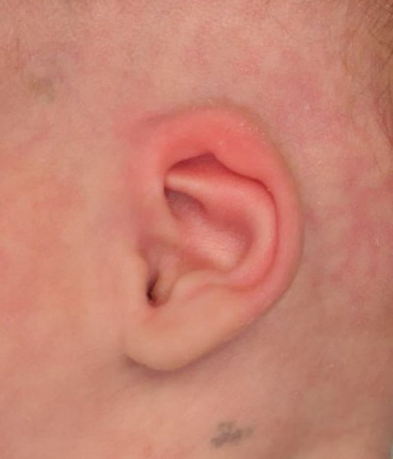 Ear Molding Before & After Gallery - Patient 768207 - Image 2