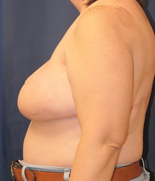 Breast Reconstruction with Implants Only Before & After Gallery - Patient 189117 - Image 10