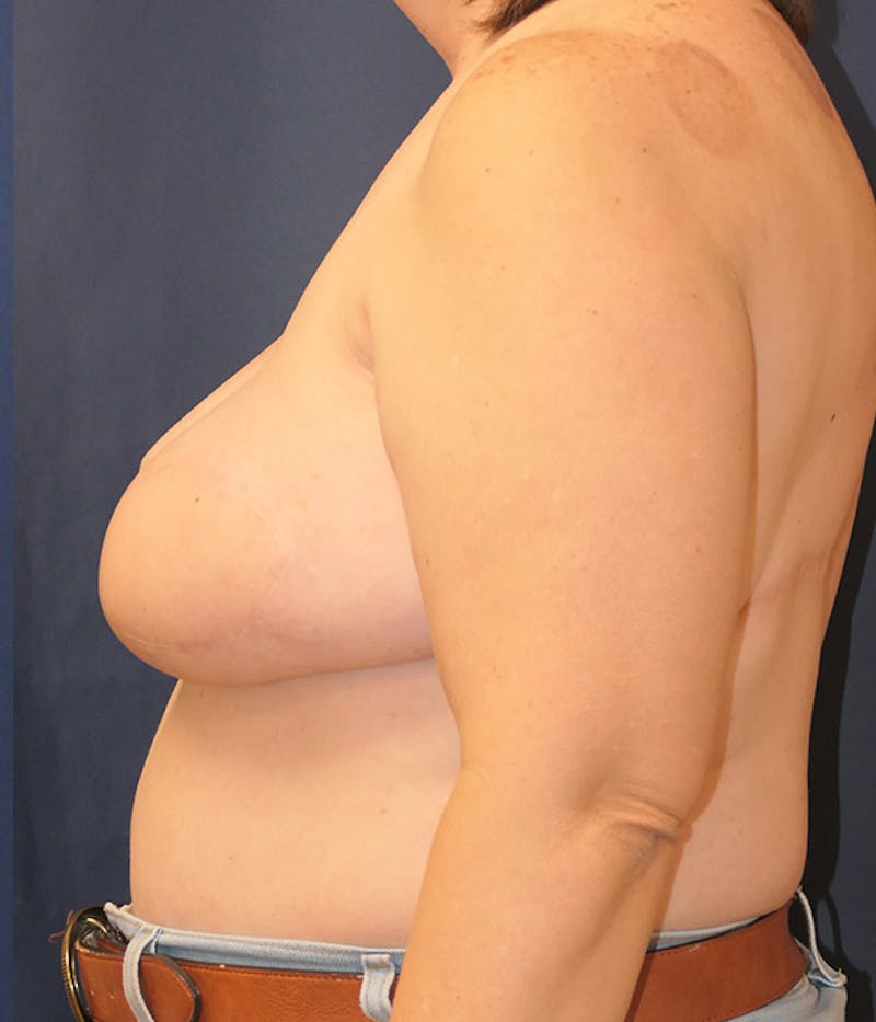 Breast Reconstruction with Implants Only Before & After Gallery - Patient 189117 - Image 10