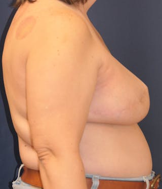 Breast Reconstruction with Implants Only Before & After Gallery - Patient 189117 - Image 6