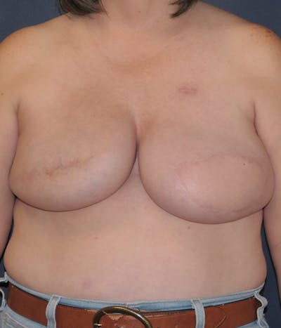 Breast Reconstruction with Implants Only Before & After Gallery - Patient 189117 - Image 2