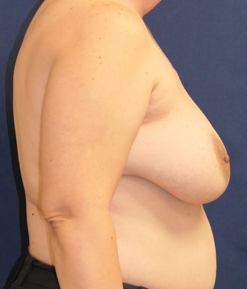 Breast Reconstruction with Implants Only Before & After Gallery - Patient 189117 - Image 5