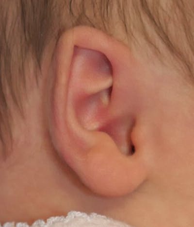 Ear Molding Before & After Gallery - Patient 365852 - Image 1