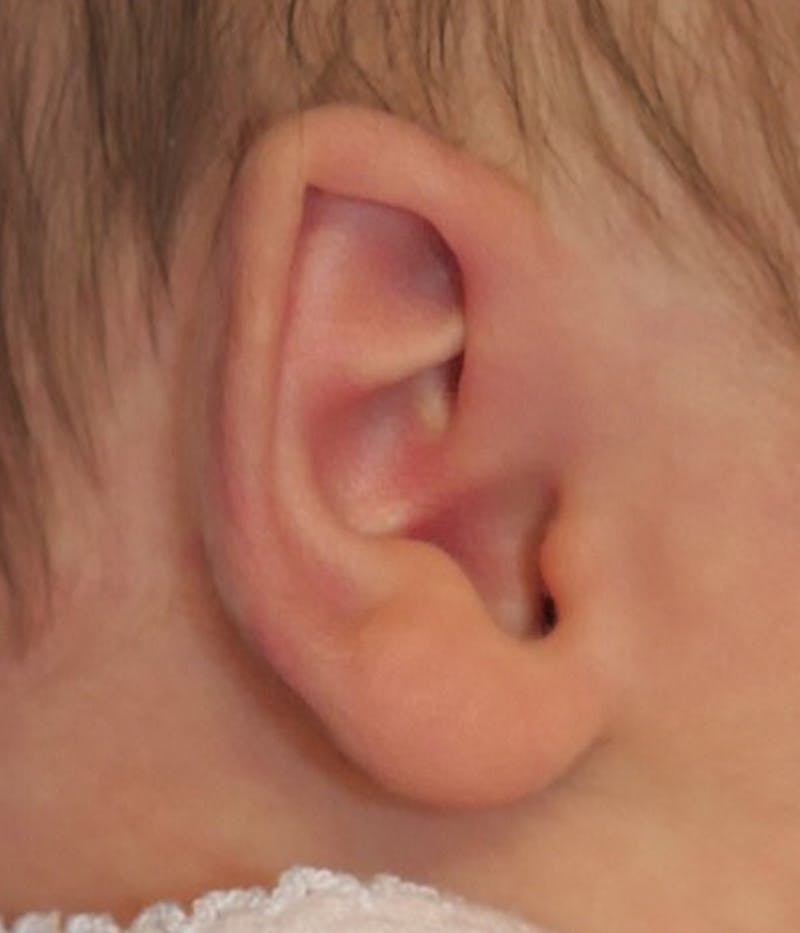 Ear Molding Before & After Gallery - Patient 365852 - Image 1