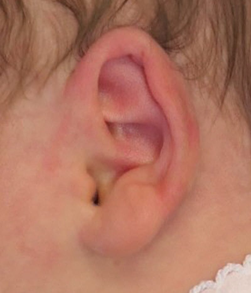 Ear Molding Before & After Gallery - Patient 365852 - Image 3